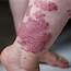 Can You Clear Eczema By Avoiding Triggers  The Peoples Pharmacy