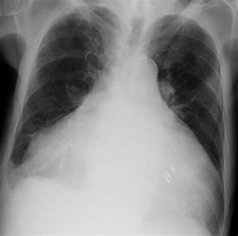 The pleura is a thin membrane that lines the inside of the chest wall and covers the lungs. Chest x-ray showing cardiomegaly and right pleural ...