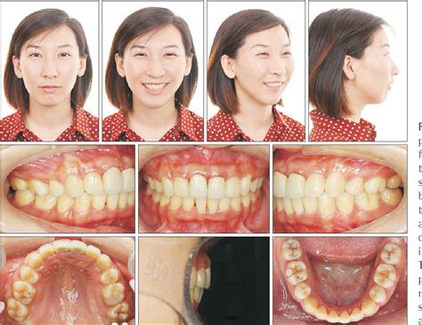 At georgetown orthodontics, our orthodontist dr. Figure 8 from Nonsurgical correction of a severe anterior ...