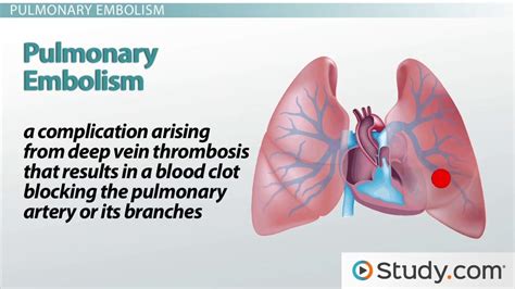 Pulmonary Embolism What Is It And Why Does It Occur Video And Lesson