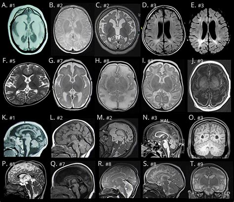 Spectrum Of Structural Brain Anomalies In Qars Associated Microcephaly
