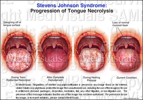 Stevens Johnson Syndrome Progression Of Tongue Necrolysis Medical Exhibit