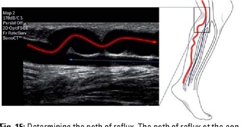 Lower Extremity Venous Insufficiency Duplex Ultrasound To The Rescue