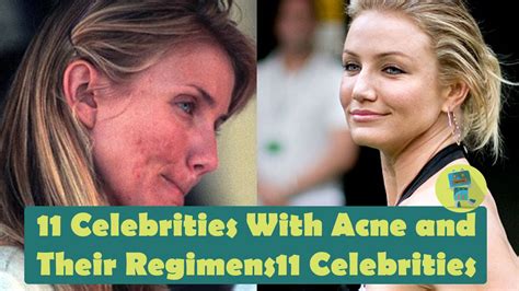 11 Celebrities With Acne And Their Regimens Youtube