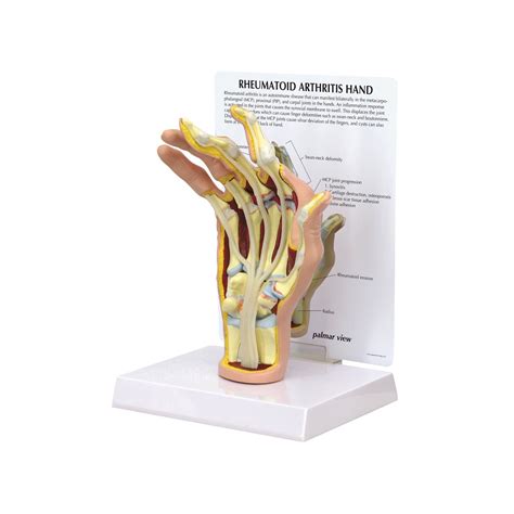 Handmodell Mit Rheumatoider Arthritis Gpi Anatomicals 1931 1019521