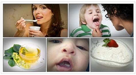 Make Use Of 16 Home Remedies For Oral Thrush To Get Healthy Mouth V Kool