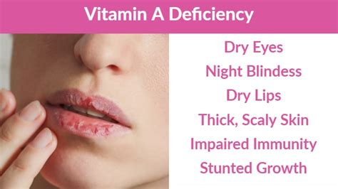 Are Dry Lips A Sign Of Vitamin Deficiency
