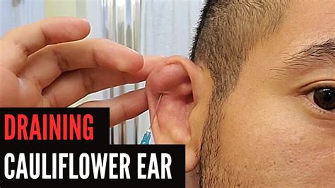 How To Drain Cauliflower Ear Youtube