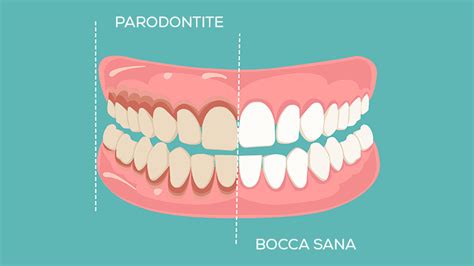 Parodontologia Cosè Tipologie E Trattamenti