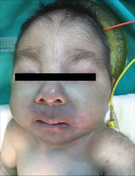 Trisomy 18 Edwards Syndrome Causes Symptoms Life Expectancy And Treatment