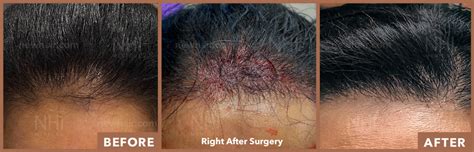 Nhi Medical Hairline Lowering Surgery New Hair New You