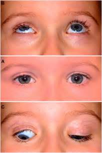 Icd 10 Code For Ptosis Bilateral Eyelids