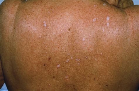 Lichen Sclerosus Causes Symptoms Treatment