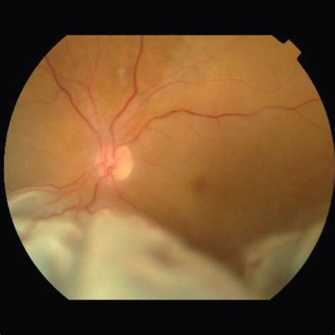 Retinal Detachment Eye Doctors Mona Vale