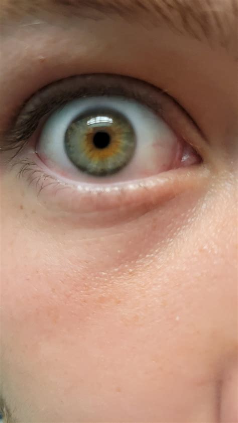 Hazel Eyes Or Central Heterochromia Ive Always Thought That I Have