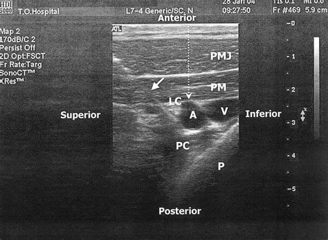 Ultrasound Guided Infraclavicular Brachial Plexus Block Download