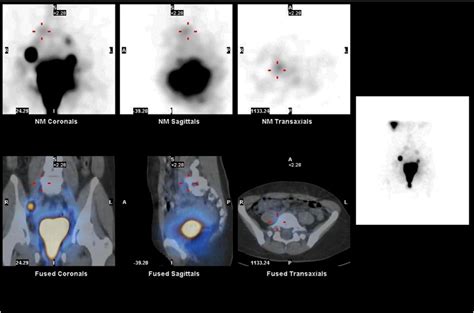 Hybrid Imaging By Spectct For Sentinel Lymph Node Detection In