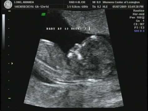 Can you tell gender at 12 weeks? Pregnancy and birth websites, pregnancy ultrasound ...