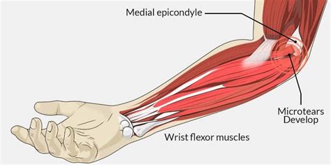 Sports Injury Conditions Golfers Elbow The Body Rehab