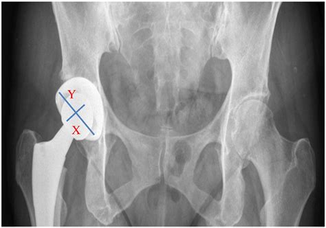 Accuracy Of Fluoroscopic Guided Acetabular Component Positioning During