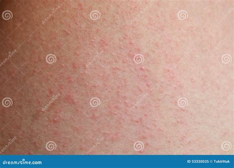 Peau Impétueuse Allergique De Dermatite Image Stock Image Du