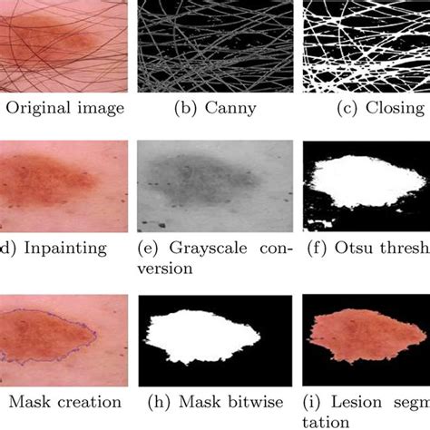 The Skin Lesion Image Processing Download Scientific Diagram