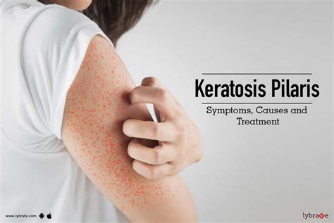 Keratosis Pilaris Symptoms Causes And Treatment By Dr Nivedita Dadu Lybrate