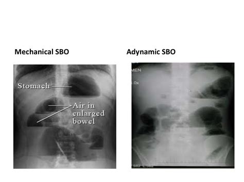 Plain Radiography In Acute Abdomen