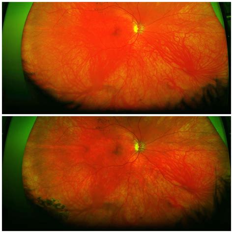 Before And After Laser Photocoagulation Roptometry