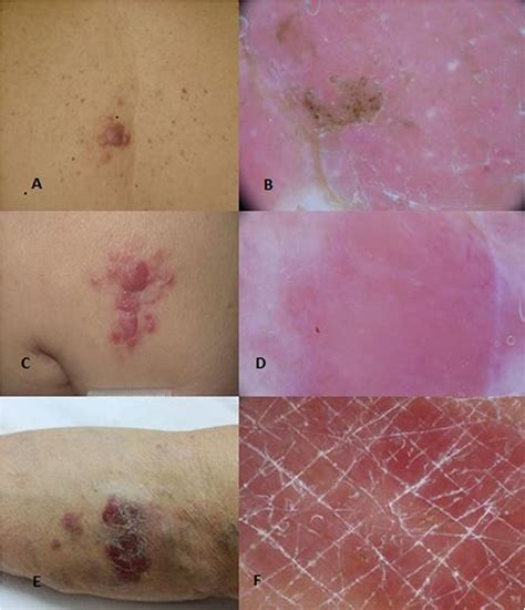 Frontiers Primary Cutaneous B Cell Lymphomas An Update Oncology