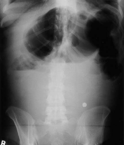 31 Year Old Woman With Post Operative Ileus Mimicking Distal Colonic