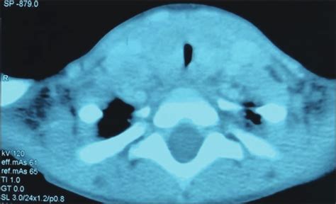 Neck Ct Without Contrast Showing Diffuse Thyroid Enlargement Bilateral
