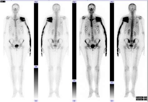 Whole Body Bone Scintigraphy Significant Locally Inhomogeneous