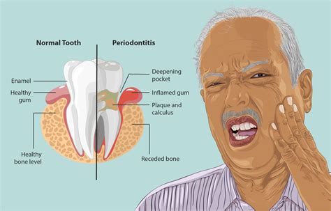 Periodontitis A Common Disease