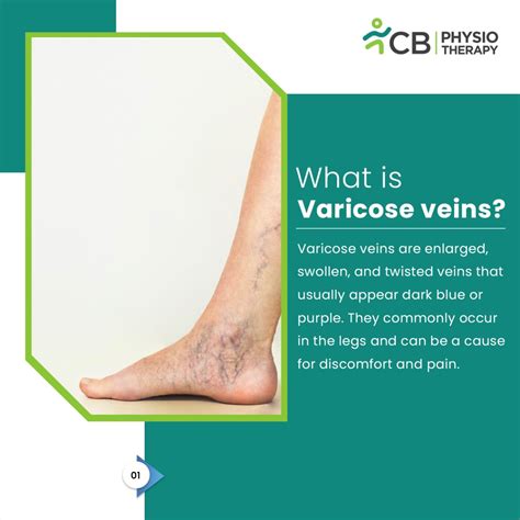 What Is Varicose Veins Its Causes Symptoms And Physiotherapy Treatment