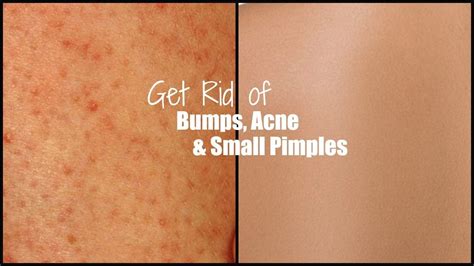 Pin By Norma Avitia On Knowledge How To Get Rid Of Pimples Small
