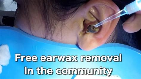 Free Earwax Removal In The Community Part 5 Youtube