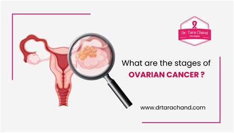 What Are The Stages Of Ovarian Cancer Medical Oncologist In Jaipur