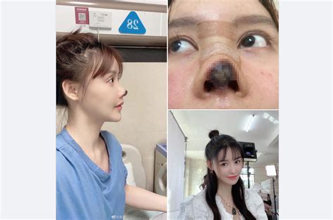 Chinese Plastic Surgery Before And After