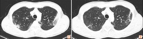 Chest Ct Shows Subpleural Consolidation And Ground Glass Opacities In