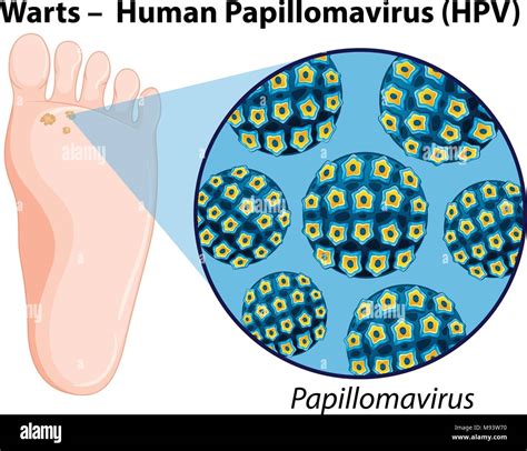 Diagrama Que Muestra La Ilustraci N Del Virus Del Papiloma Humano Imagen Vector De Stock Alamy