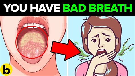 9 Causes Of Bad Breath And How To Fix It Sports Health And Wellbeing