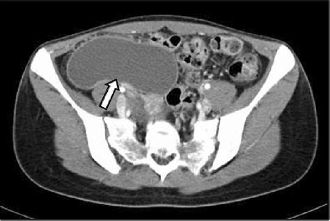 Abdominopelvic Ct Scan Showed A 8×6 Cm Sized Non Enhancing Thin