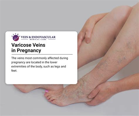 Bulging Painful Leg Veins During Pregnancy Can They Be Treated Vein