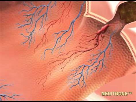 80% of lower gi bleeding will resolve spontaneously. Lower GI Bleed - Meditoons™ - YouTube