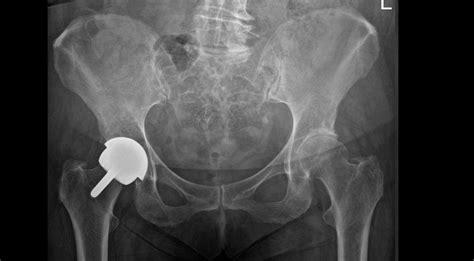 Hip Replacement History