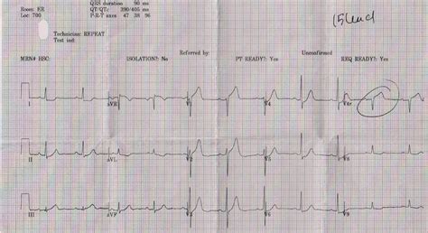 Dr Smiths Ecg Blog Septal Stemi With St Elevation In V1 And V4r And