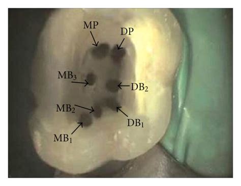A Picture Of The Access Cavity Of The Maxillary First Molar Showing Download Scientific