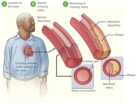 Coronary Heart Disease Case Study Ppt