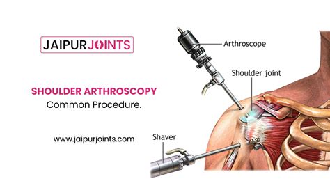 Shoulder Arthroscopic Common Procedures By Dr Lalit Modi Jaipurjoints